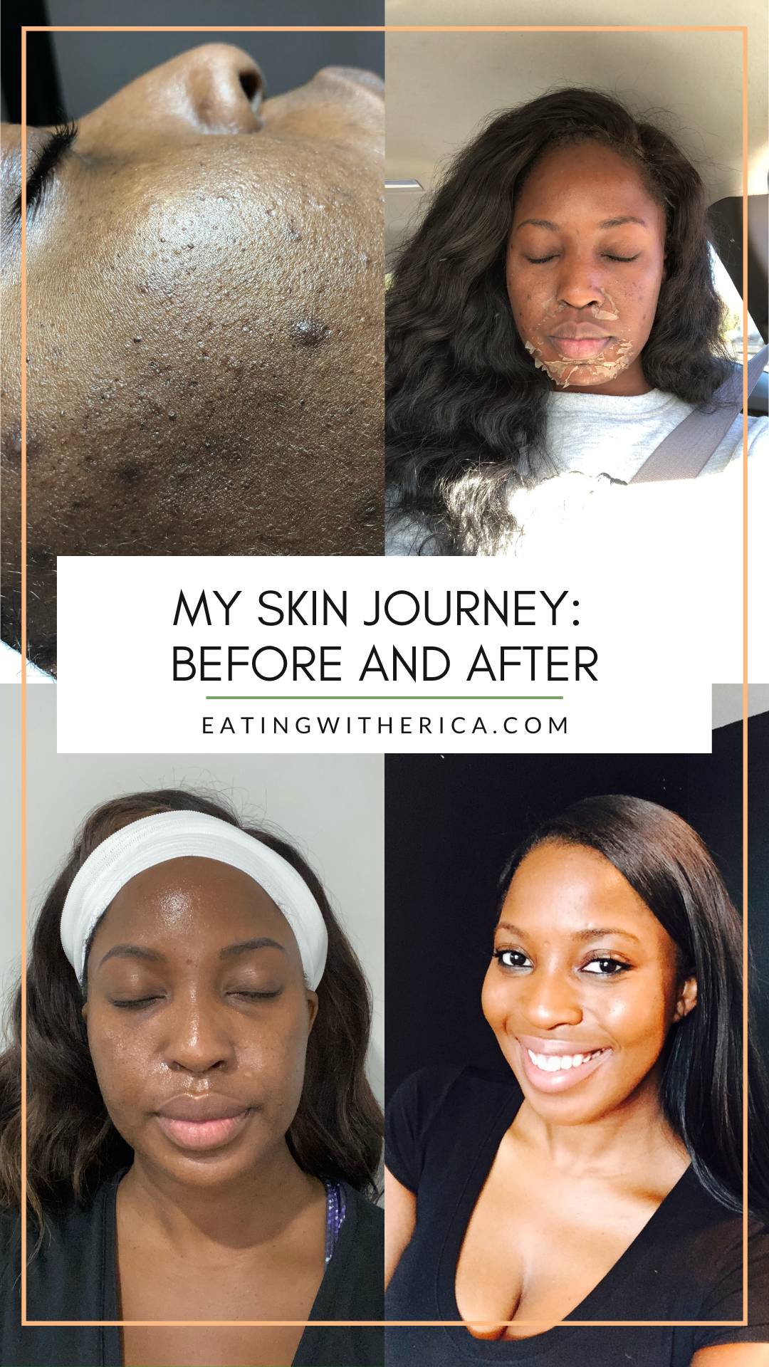 Currently on a skin journey? Join Atlanta Lifestyle Blogger Eating with Erica as she shares her personal skin journey and what she did HERE!